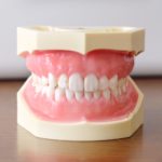 all on 4インプラントのメリット